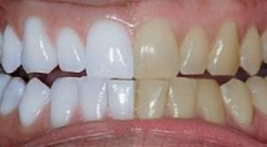 Dentes amarelados: saiba como evitar desde cedo