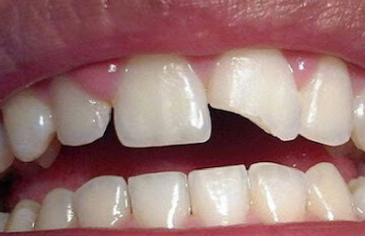  Dente quebrado? Descubra o que você deve fazer!